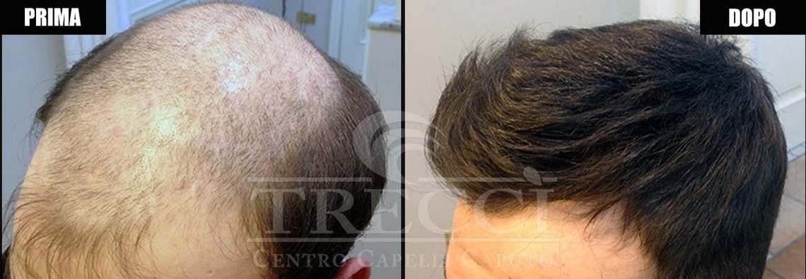 protesi capelli per alopecia